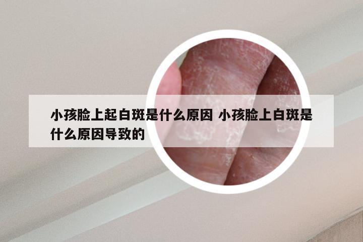 小孩脸上起白斑是什么原因 小孩脸上白斑是什么原因导致的