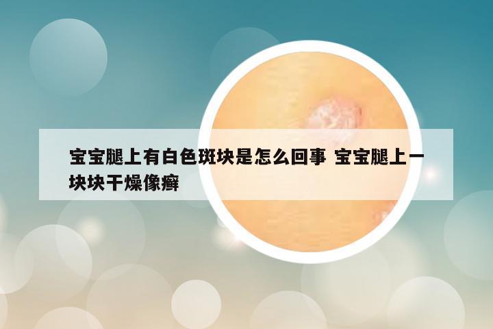 宝宝腿上有白色斑块是怎么回事 宝宝腿上一块块干燥像癣