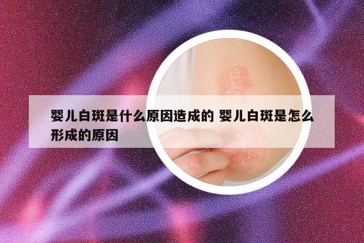 婴儿白斑是什么原因造成的 婴儿白斑是怎么形成的原因