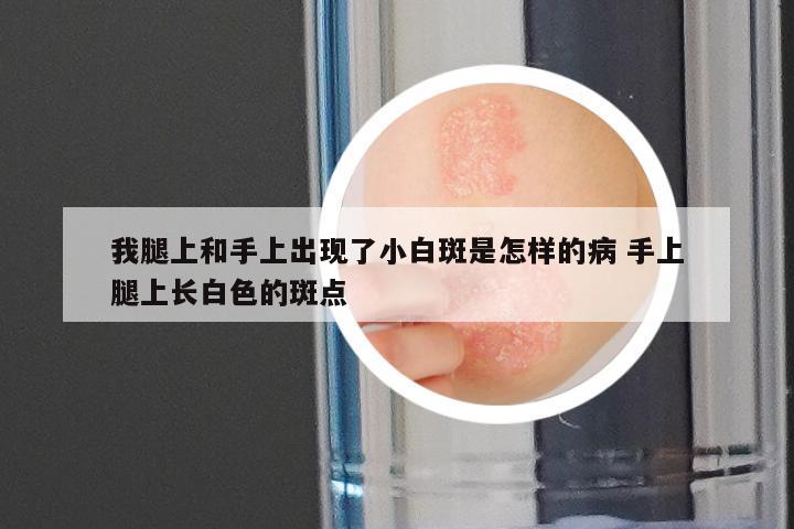 我腿上和手上出现了小白斑是怎样的病 手上腿上长白色的斑点