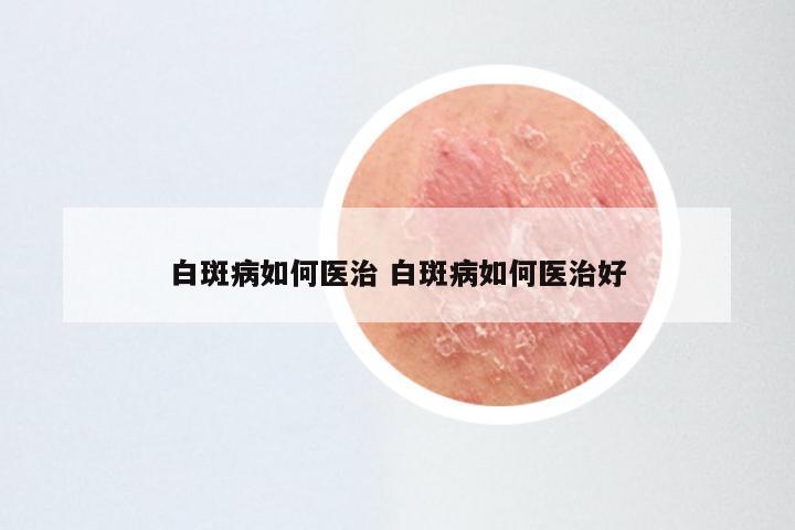 白斑病如何医治 白斑病如何医治好