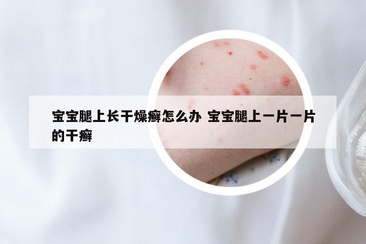 宝宝腿上长干燥癣怎么办 宝宝腿上一片一片的干癣