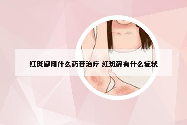 红斑癣用什么药膏治疗 红斑藓有什么症状