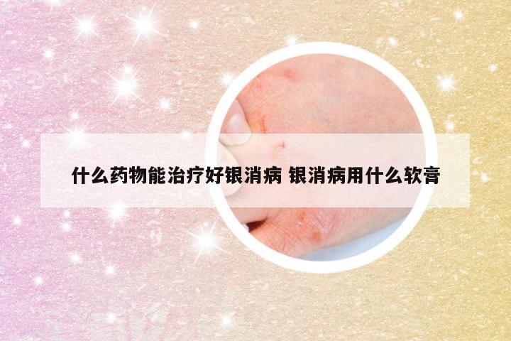 什么药物能治疗好银消病 银消病用什么软膏