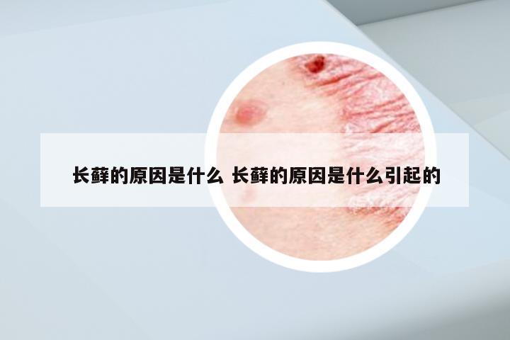 长藓的原因是什么 长藓的原因是什么引起的