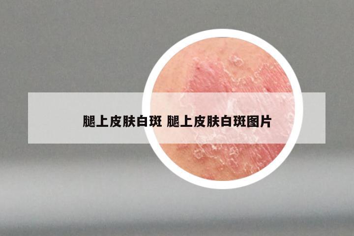 腿上皮肤白斑 腿上皮肤白斑图片