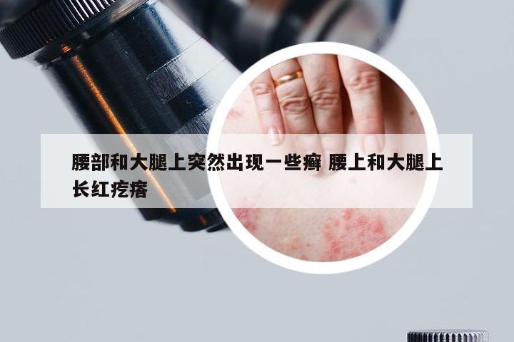 腰部和大腿上突然出现一些癣 腰上和大腿上长红疙瘩