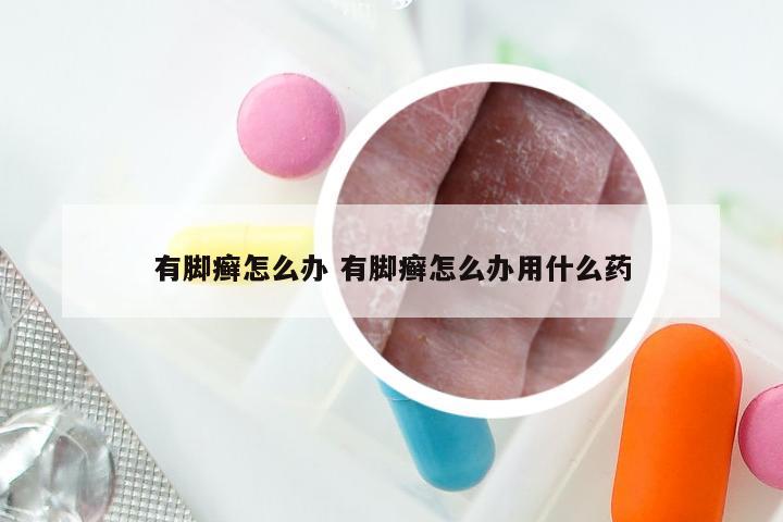 有脚癣怎么办 有脚癣怎么办用什么药