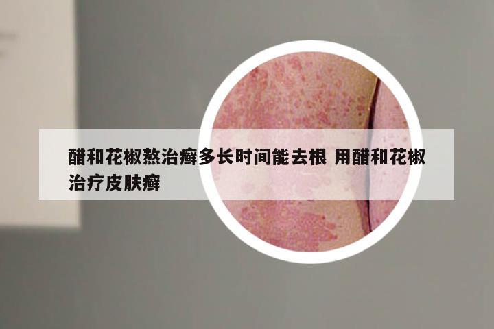 醋和花椒熬治癣多长时间能去根 用醋和花椒治疗皮肤癣