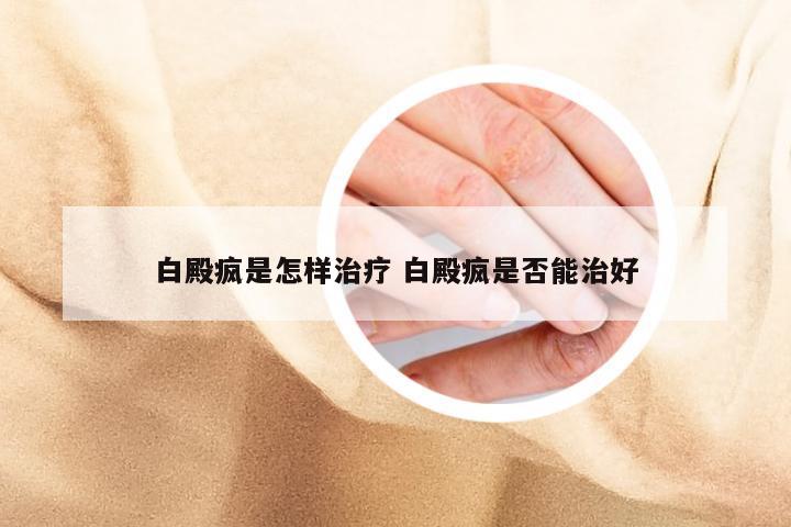 白殿疯是怎样治疗 白殿疯是否能治好