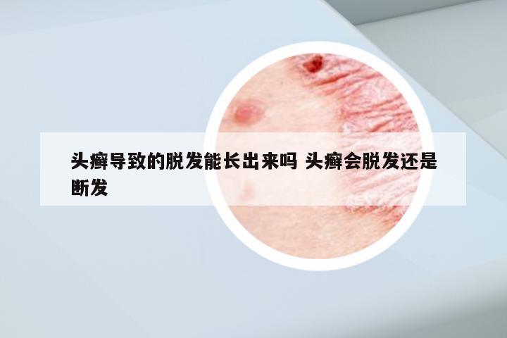 头癣导致的脱发能长出来吗 头癣会脱发还是断发