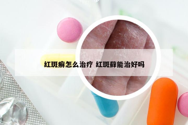 红斑癣怎么治疗 红斑藓能治好吗