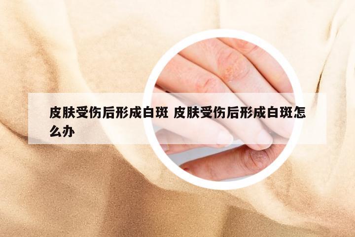 皮肤受伤后形成白斑 皮肤受伤后形成白斑怎么办