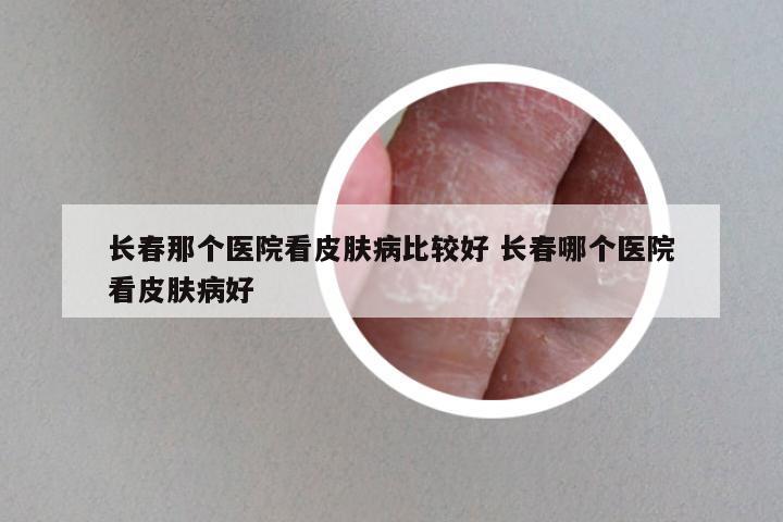 长春那个医院看皮肤病比较好 长春哪个医院看皮肤病好