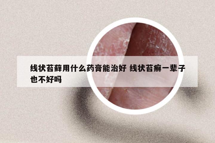 线状苔藓用什么药膏能治好 线状苔癣一辈子也不好吗