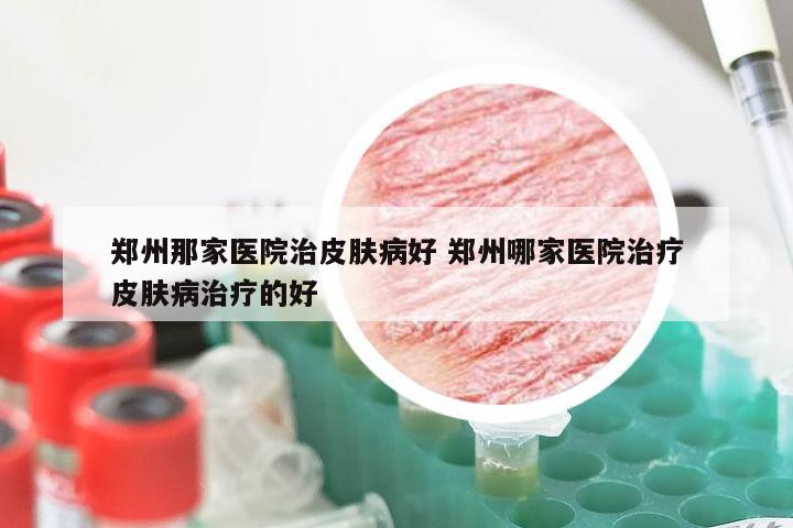 郑州那家医院治皮肤病好 郑州哪家医院治疗皮肤病治疗的好