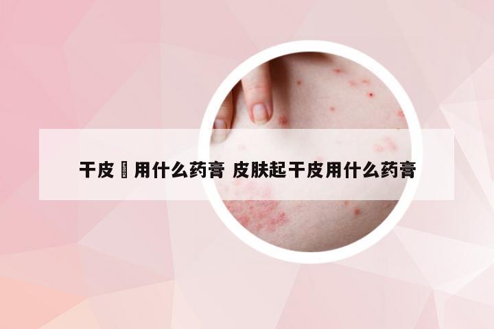 干皮廯用什么药膏 皮肤起干皮用什么药膏