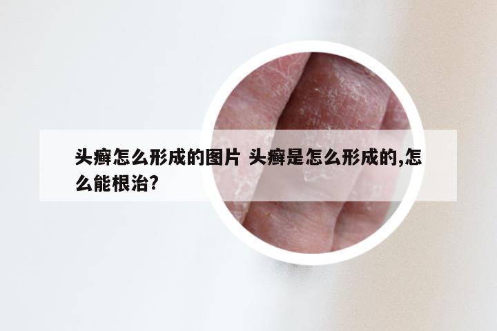 头癣怎么形成的图片 头癣是怎么形成的,怎么能根治?