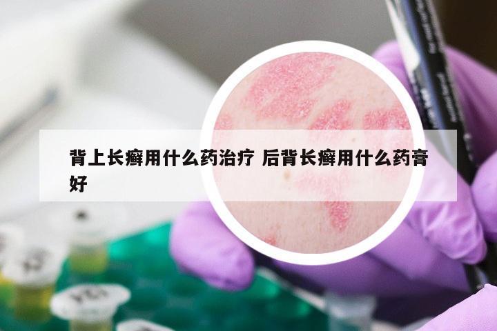 背上长癣用什么药治疗 后背长癣用什么药膏好