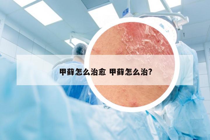 甲藓怎么治愈 甲藓怎么治?