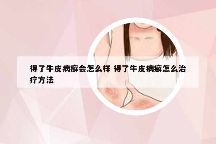 得了牛皮病癣会怎么样 得了牛皮病癣怎么治疗方法