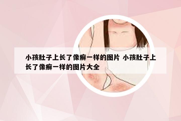 小孩肚子上长了像癣一样的图片 小孩肚子上长了像癣一样的图片大全