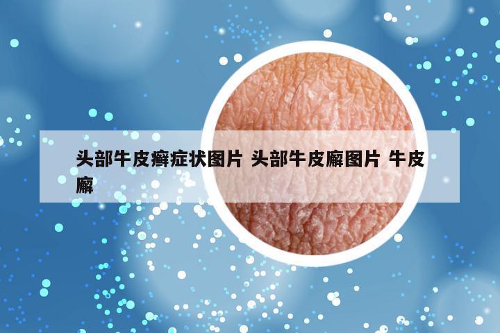 头部牛皮癣症状图片 头部牛皮廨图片 牛皮廨