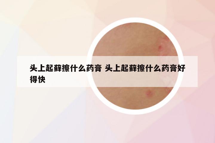 头上起藓擦什么药膏 头上起藓擦什么药膏好得快