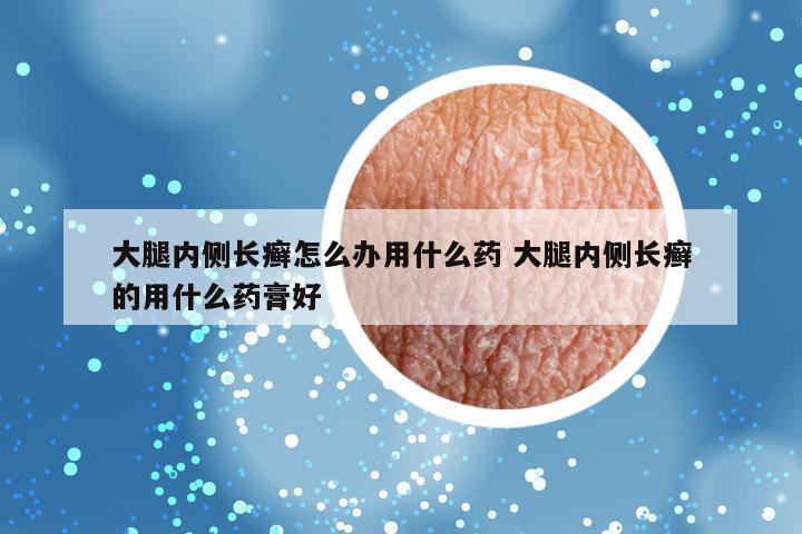 大腿内侧长癣怎么办用什么药 大腿内侧长癣的用什么药膏好