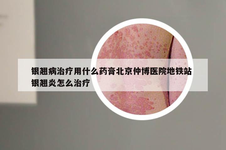 银翘病治疗用什么药膏北京仲博医院地铁站 银翘炎怎么治疗