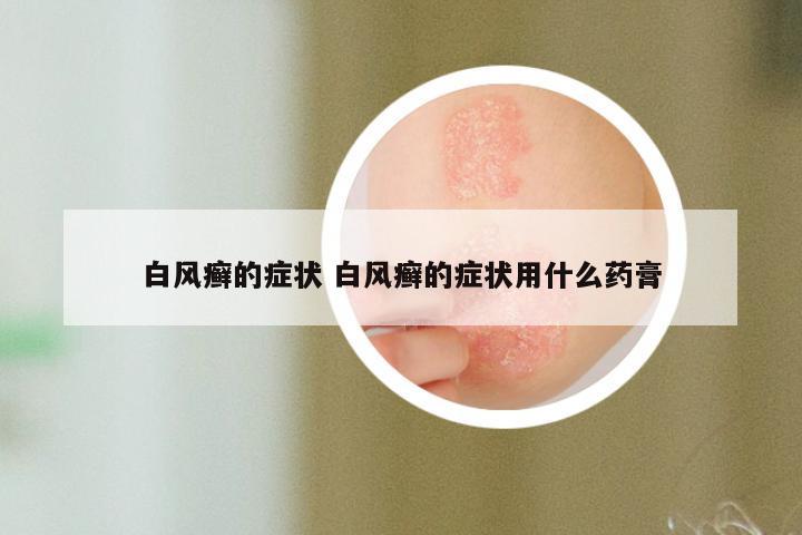 白风癣的症状 白风癣的症状用什么药膏