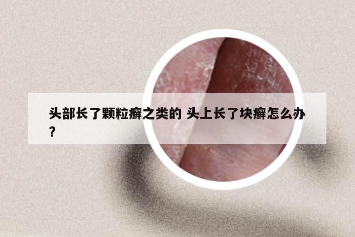 头部长了颗粒癣之类的 头上长了块癣怎么办?