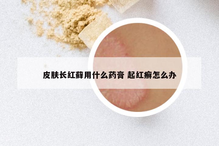 皮肤长红藓用什么药膏 起红癣怎么办