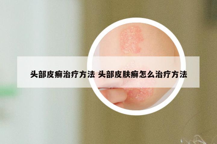 头部皮癣治疗方法 头部皮肤癣怎么治疗方法