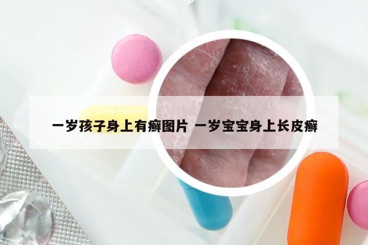 一岁孩子身上有癣图片 一岁宝宝身上长皮癣