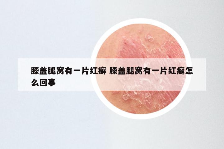 膝盖腿窝有一片红癣 膝盖腿窝有一片红癣怎么回事