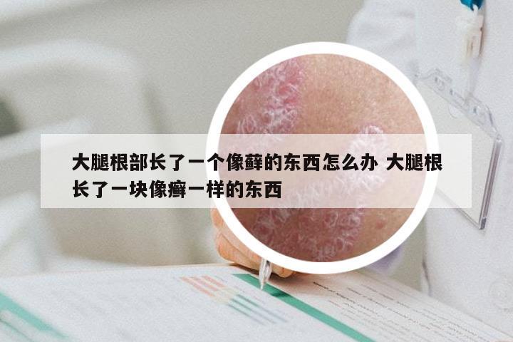 大腿根部长了一个像藓的东西怎么办 大腿根长了一块像癣一样的东西