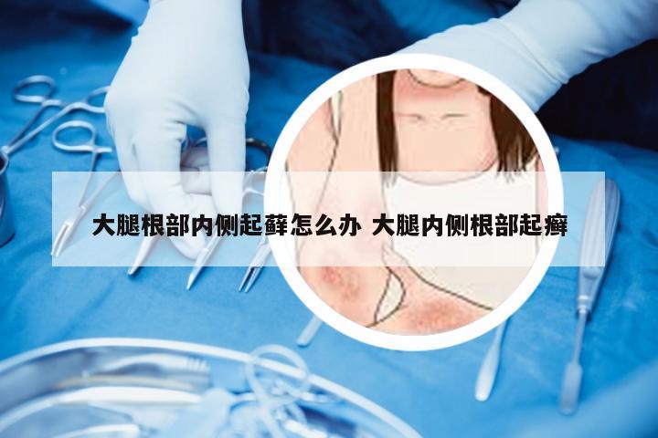 大腿根部内侧起藓怎么办 大腿内侧根部起癣