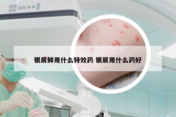 银屑鲜用什么特效药 银屑用什么药好