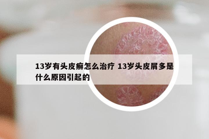 13岁有头皮癣怎么治疗 13岁头皮屑多是什么原因引起的