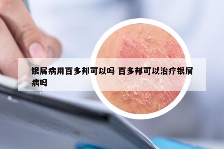 银屑病用百多邦可以吗 百多邦可以治疗银屑病吗