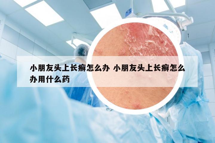 小朋友头上长癣怎么办 小朋友头上长癣怎么办用什么药