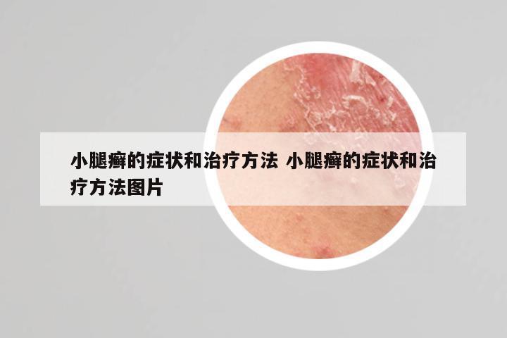 小腿癣的症状和治疗方法 小腿癣的症状和治疗方法图片