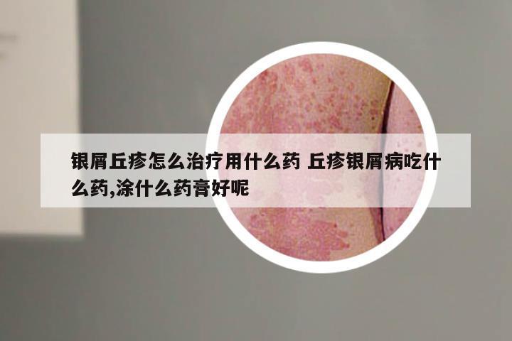 银屑丘疹怎么治疗用什么药 丘疹银屑病吃什么药,涂什么药膏好呢