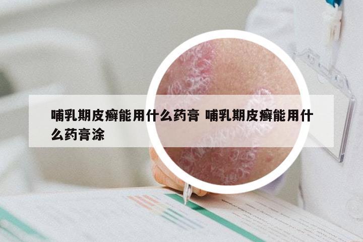 哺乳期皮癣能用什么药膏 哺乳期皮癣能用什么药膏涂