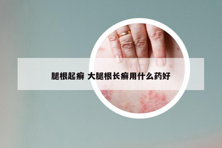 腿根起癣 大腿根长癣用什么药好