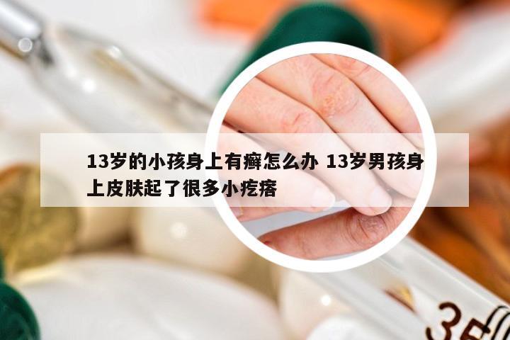 13岁的小孩身上有癣怎么办 13岁男孩身上皮肤起了很多小疙瘩