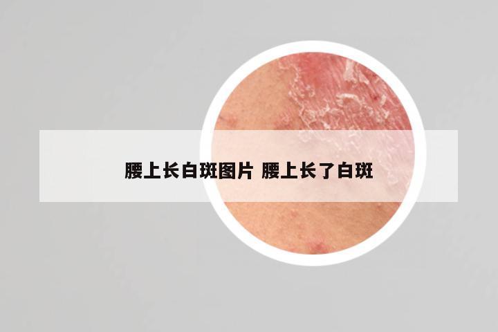 腰上长白斑图片 腰上长了白斑