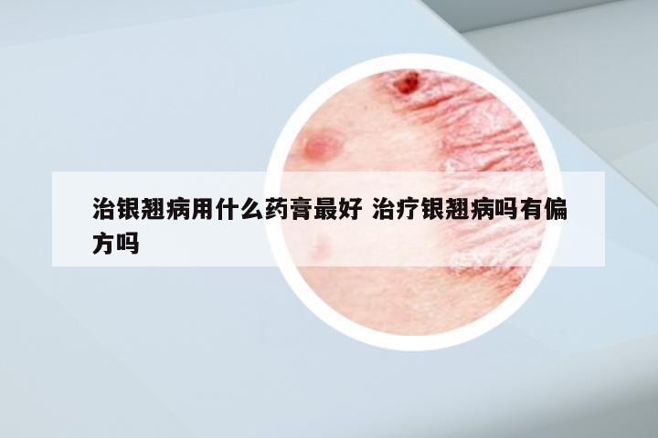 治银翘病用什么药膏最好 治疗银翘病吗有偏方吗