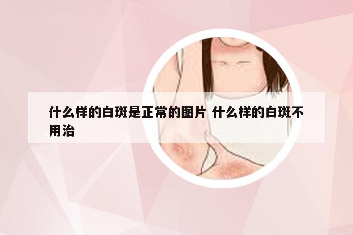 什么样的白斑是正常的图片 什么样的白斑不用治